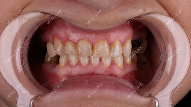 before dental implant